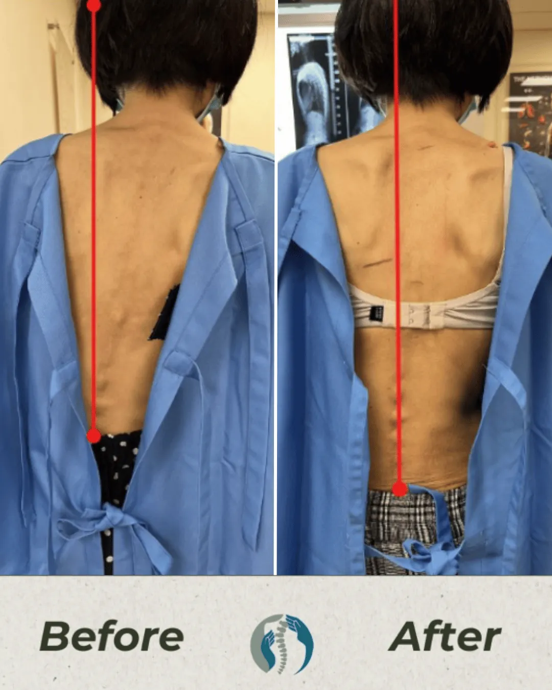Back view of the same patient in two photographs at Persistence Chiropractic Care in Cheras, Kuala Lumpur, a vertical red line in each marking the position of the head and spine