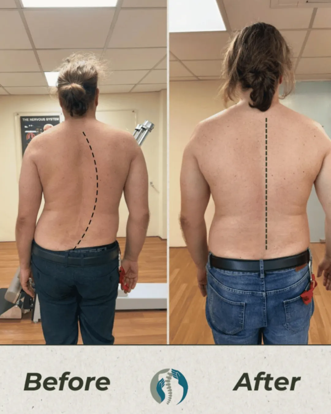 Back view of the same patient in two photographs at Persistence Chiropractic Care in Cheras, Kuala Lumpur, a dashed line in each following the line of the spine from the neck downwards