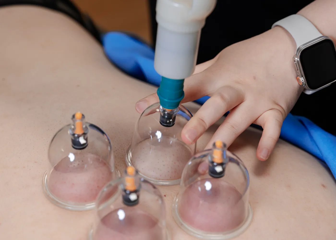 Cupping therapy applied across a patient upper back at Persistence Chiropractic Care in Cheras, Kuala Lumpur