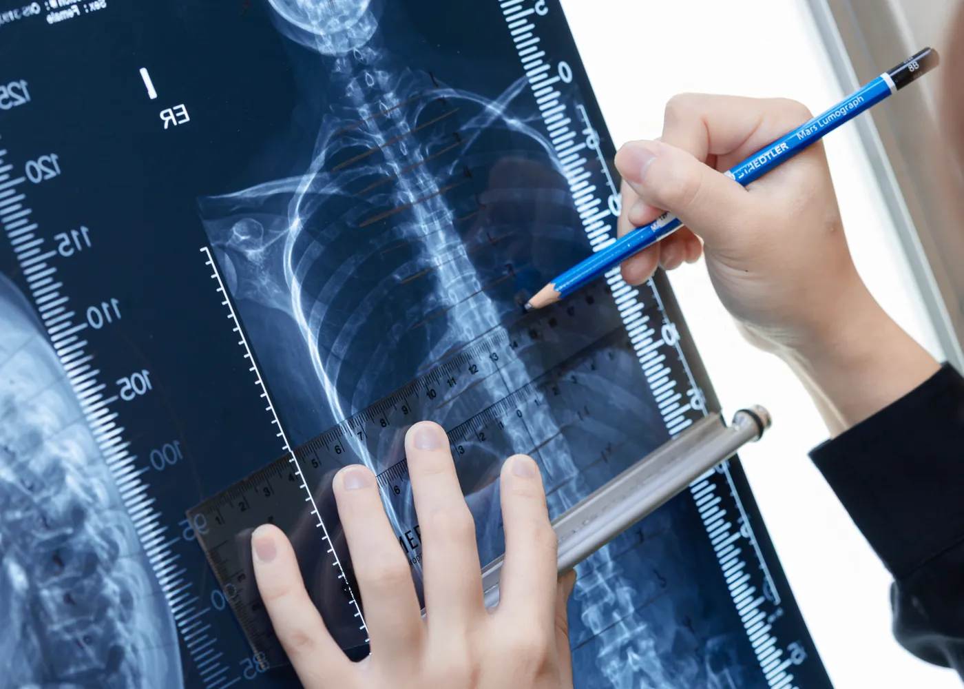 Chiropractor marking up a full-spine X-ray on a lightbox at Persistence Chiropractic Care in Cheras, Kuala Lumpur